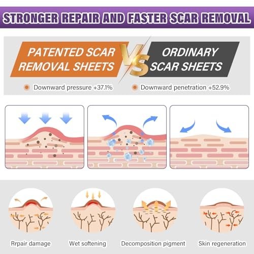 Silicone Scar Tape for Keloids Hypertrophic Scars 1.6in x 150in 3.8m Roll Kit