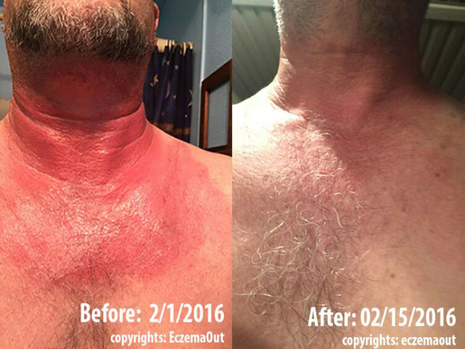 Intense Treatment Cream for Eczema Psoriasis Rosacea Dermatitis Eczemaout Acne