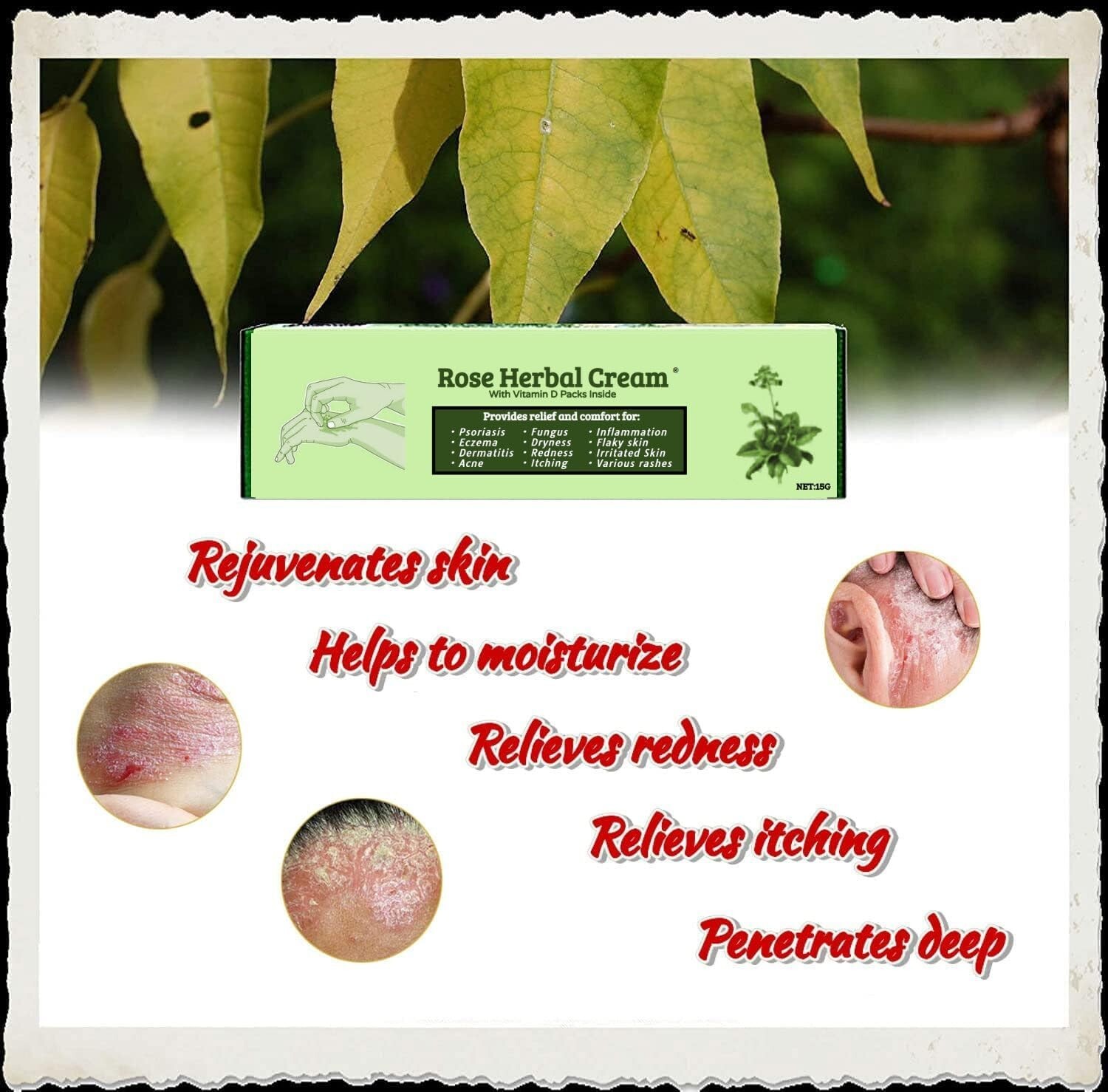 Eczema Psoriasis CREAM Ointment Inflammation Natural Anti Itching Dermatitis