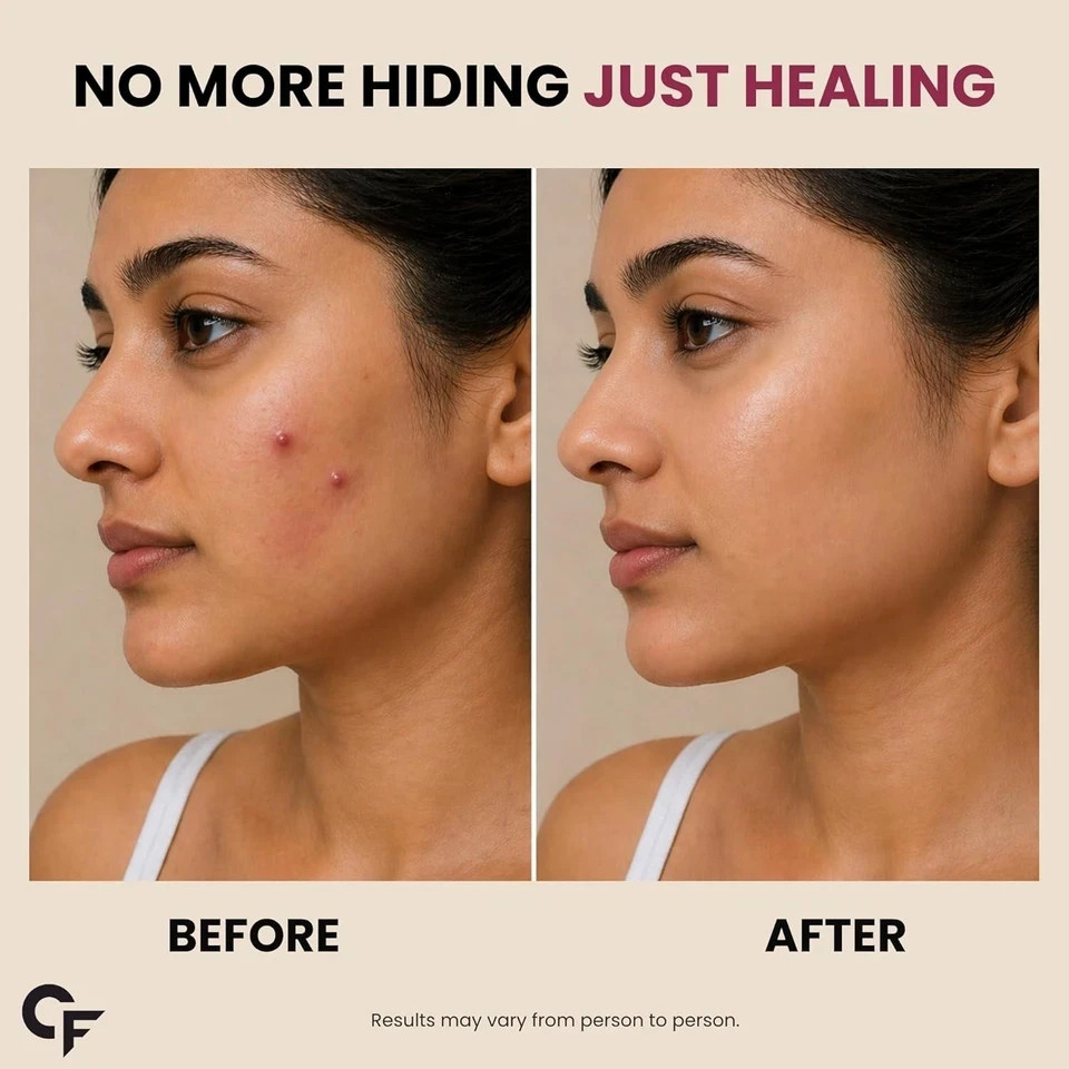 Carbamide Forte for Face Salicylic Acid & Cica 72 Hydrocolloid Pimple Patches