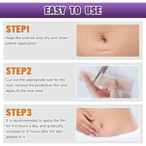 Silicone Scar Tape for Keloids Hypertrophic Scars 1.6in x 150in 3.8m Roll Kit
