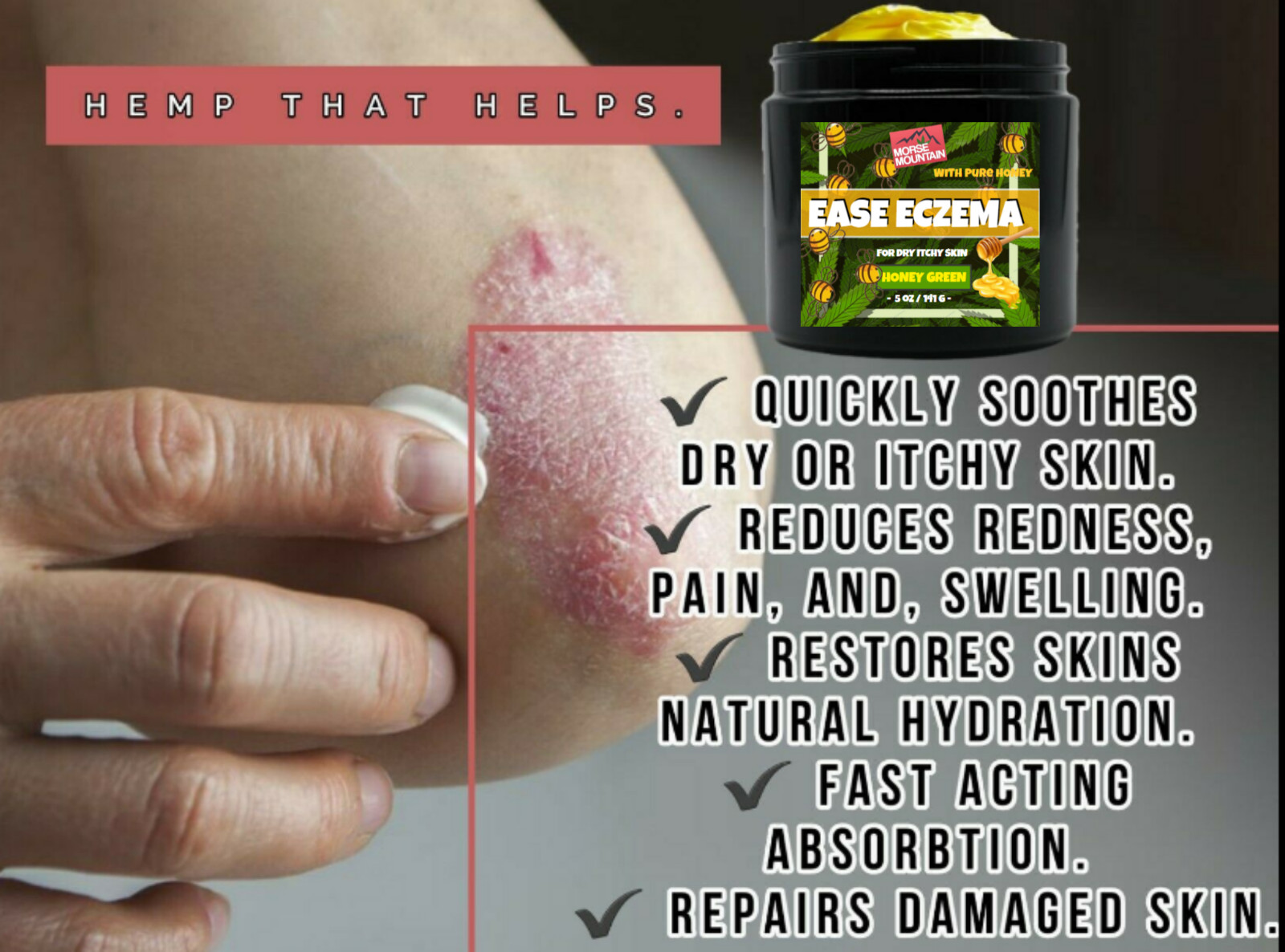 Eczema / Psoriasis Honey Ointment Cream Natural Dermatitis Treatment