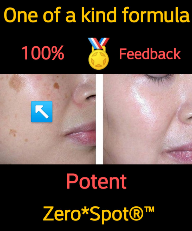 Sun Spot, Age Spot, Brown Spot, Dark Spot Corrector Treatment Remover: No Scam💙