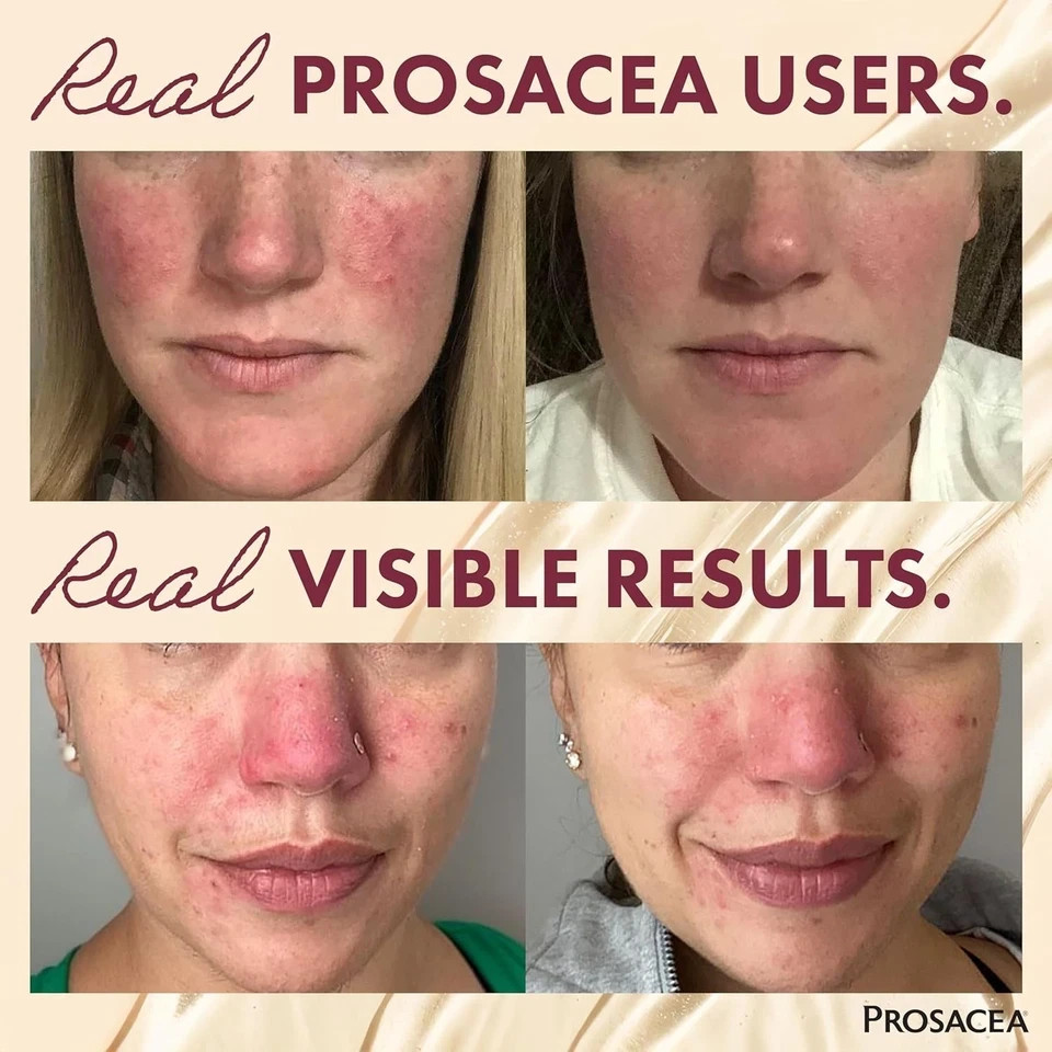 Prosacea Medicated Rosacea Treatment for Face – Reduce Redness & Rosacea Symptom