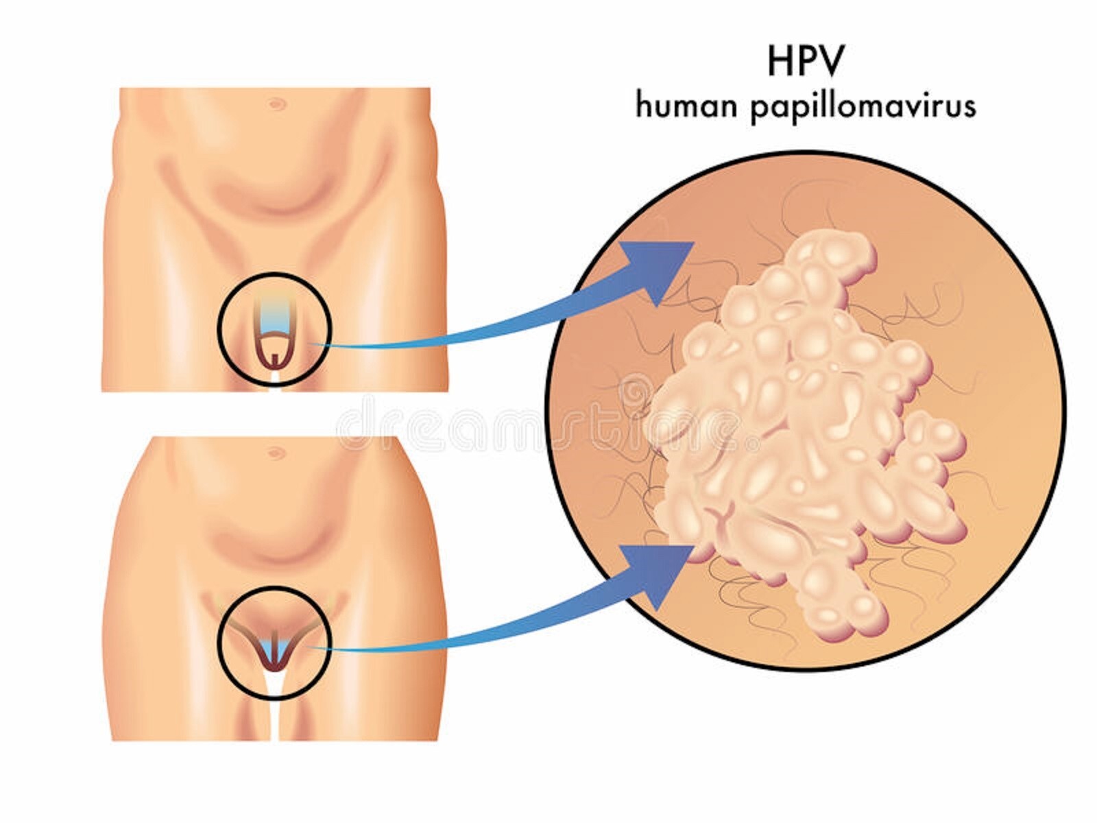 NATURAL HELP FOR HPV FREEPAPILLOMA MEN & WOMEN – MADE IN USA