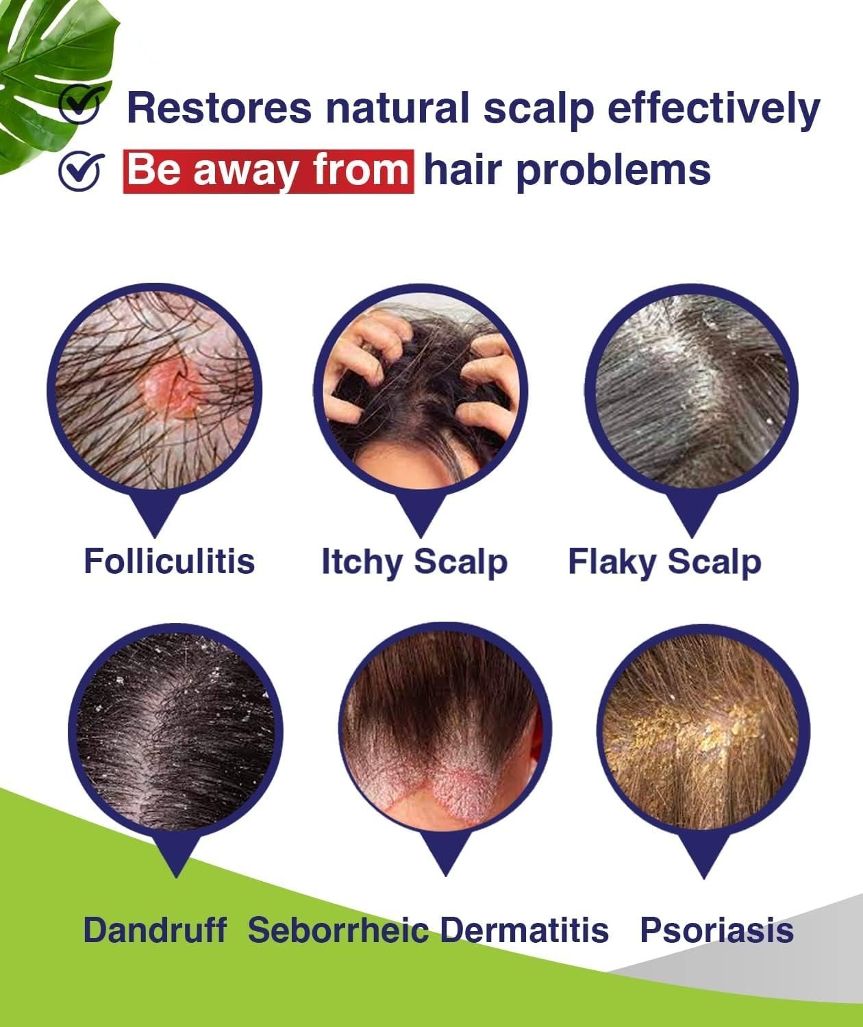 Anti-Fungal Shampoo for Folliculitis, Seborrheic Dermatitis, Scalp Psoriasis – I