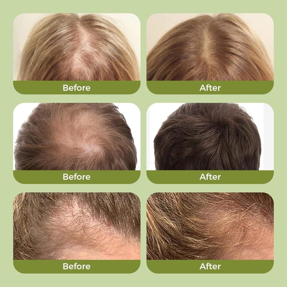 2 Pack Organic Rosemary Hair Growth Shampoo for Women and Men-Natural Thickening