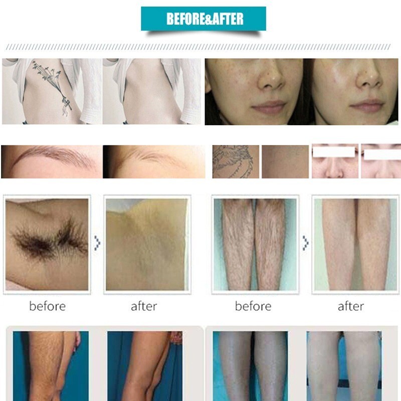2IN1 808nm Diode Laser Hair Removal Pico NG YAG Laser Tattoo Beauty Machine