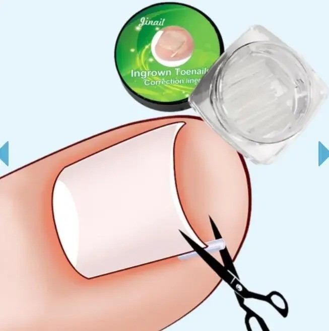 Ingrown Toenail Correction Patch Ultra Thin Elastic Nail Treatment Sticker Tool