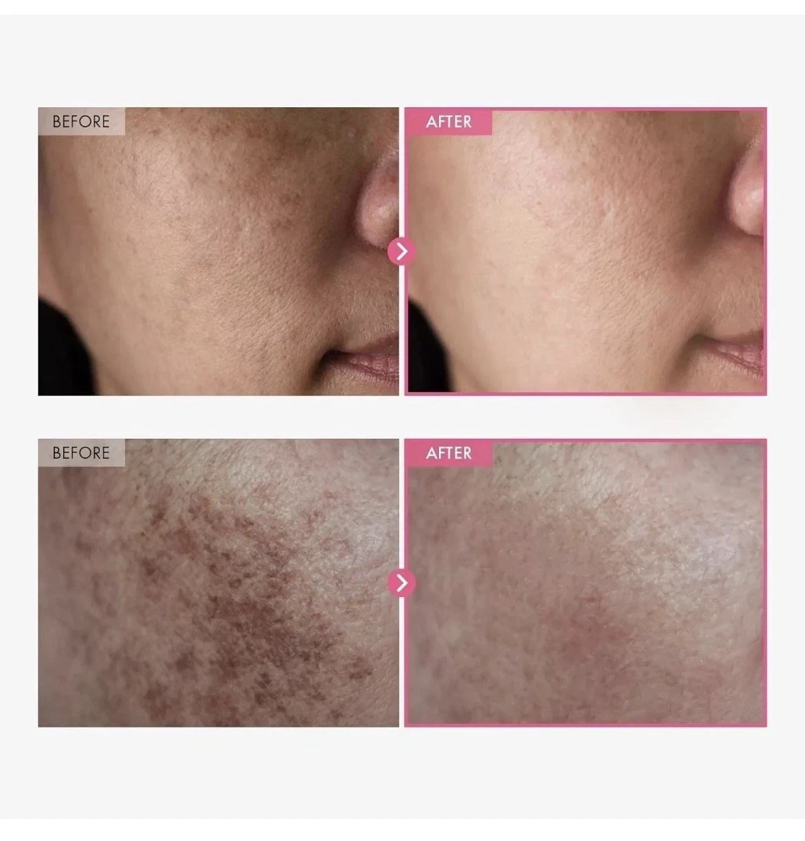 2 PCK-Arbutin7% Tranexamic Acid 4% Cream 50ml Brightening K Beauty FREE SHIP