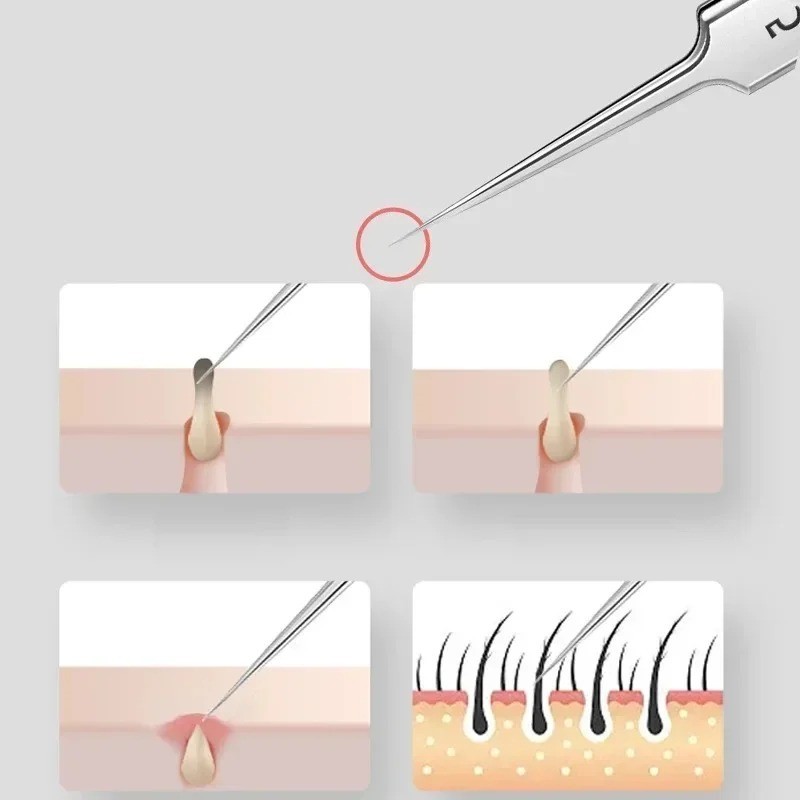 3Professional Tweezers Ultra-fine No. 5 Acne Blackhead Removal Beauty Salon Tool