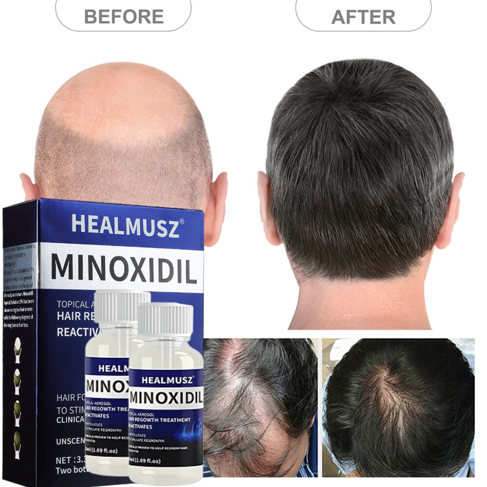 2 Pack Minoxidil 5% Extra Strength Men Hair Regrowth Treatment 2 Month Supply